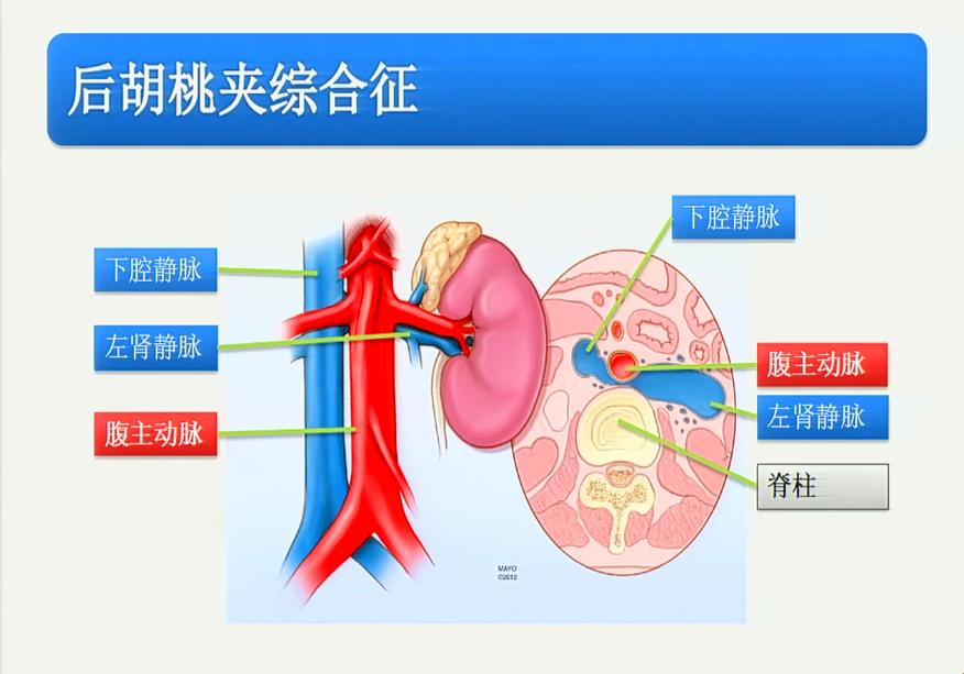 "胡桃夹"精索静脉曲张，网民热议：这病魔是个“技术活”！