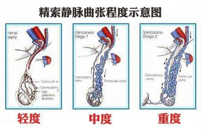 胡桃夹精索静脉曲张能治好吗——探索未知领域