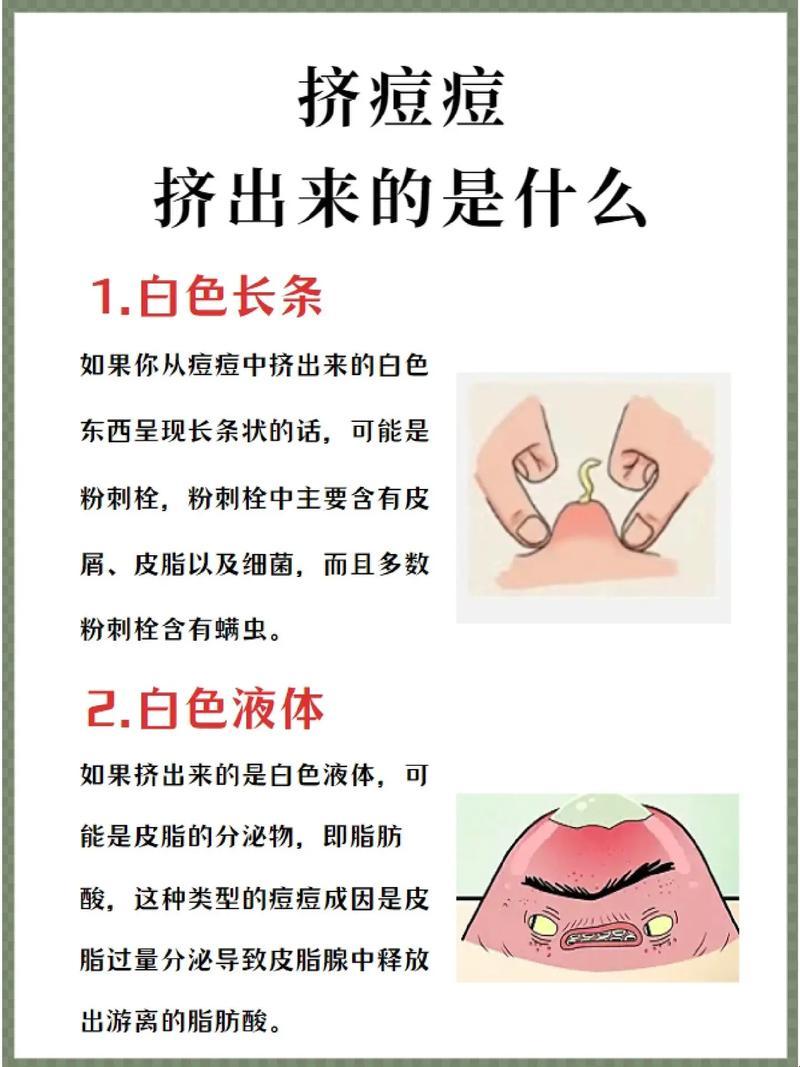 粉刺非得“血溅三尺”才罢休？